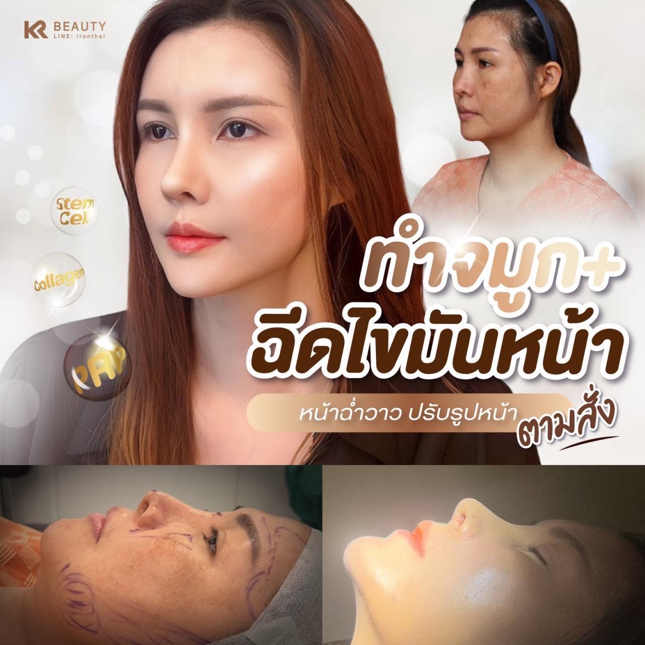 LINE_ALBUM_Fatgrafting KR logo_240117_19