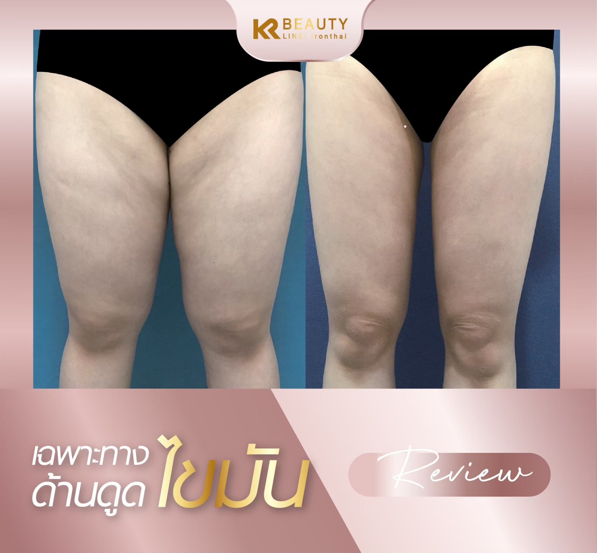 LINE_ALBUM_body liposuction_240303_2